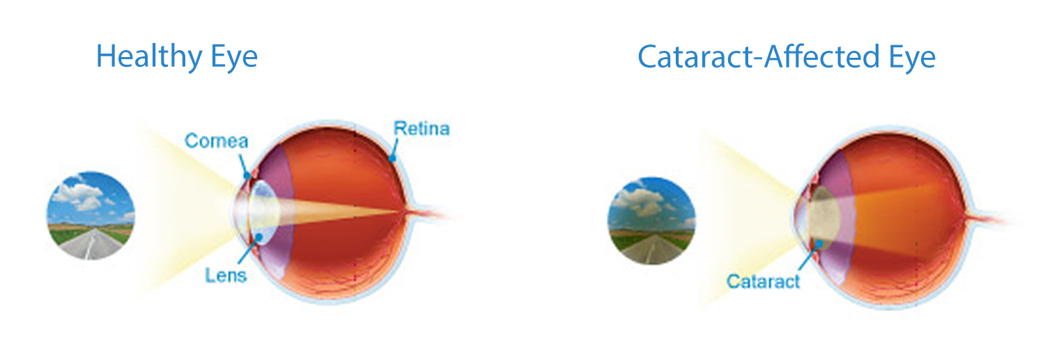 cataract-eyes